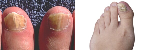 Anti Fungal Nail Treatment Set Finger Toe Nail Fungus Care Treatment  Solution AU | eBay